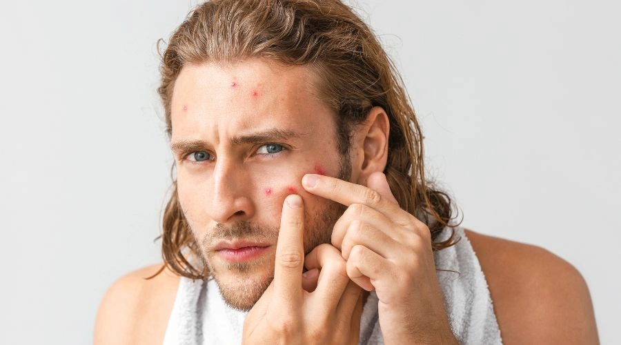 Man with facial blemishes reviewing alcohol’s Influence on his skin