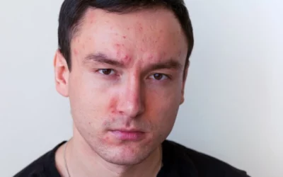 Does Alcohol Cause Acne?