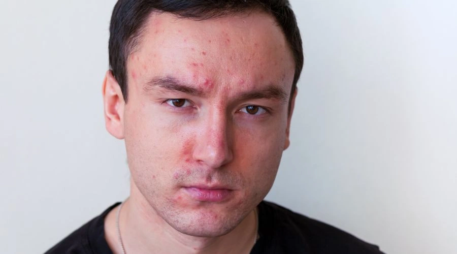 Does Alcohol Cause Acne